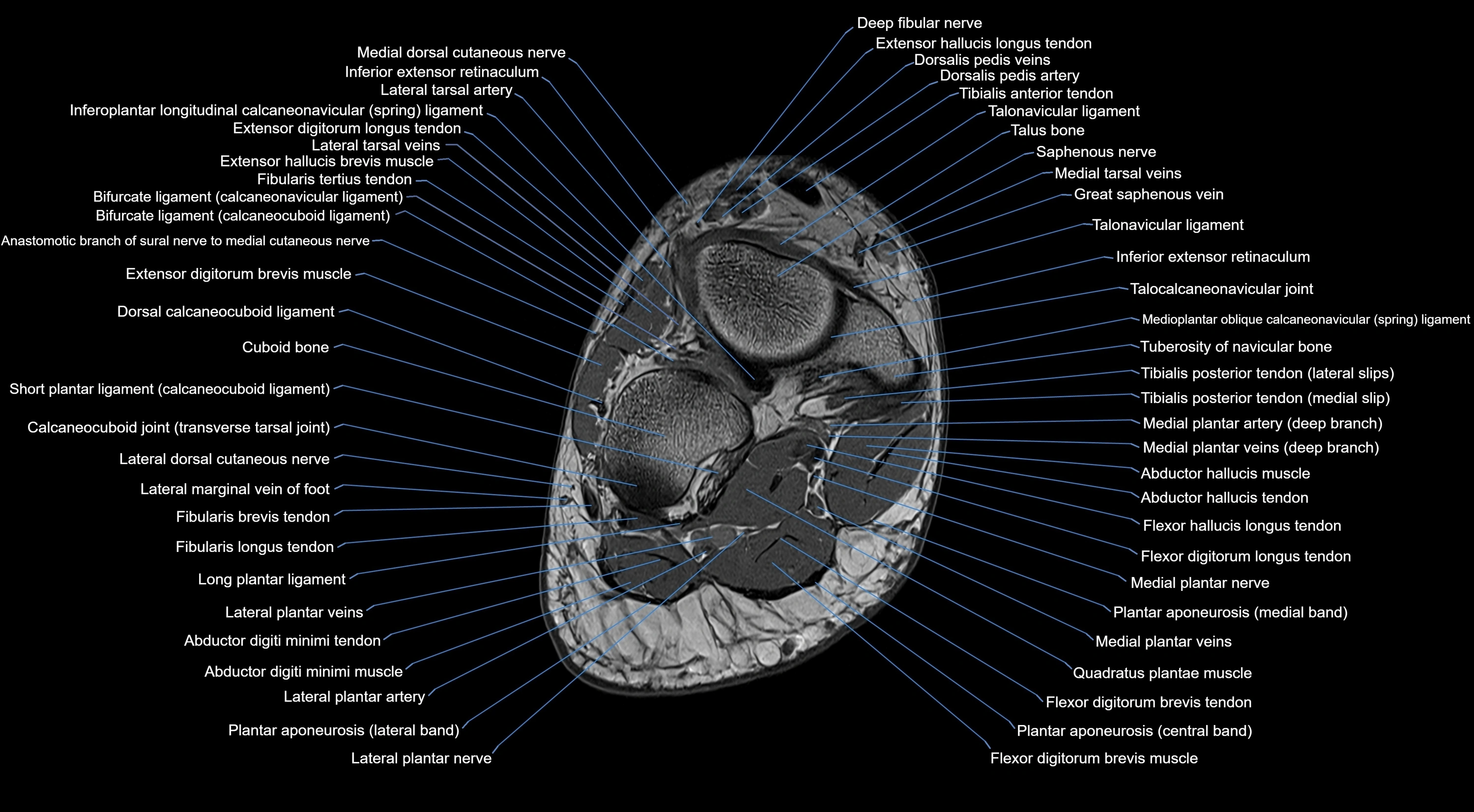 MRI mid foot coronal ligaments cross sectional anatomy 3T  radiology  image-img-00001-00034.webp